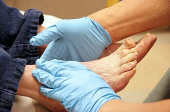 diabetic foot treatment in Pasadena, Baytown, League City, Pearland, Houston, TX
