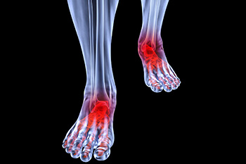 arthritic foot and ankle care treatment in Baytown, League City, Pearland, Houston, Pasadena, TX