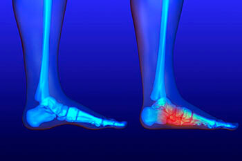 Flat feet and Fallen Arches treatment in Pasadena, Baytown, League City, Pearland, Houston, TX