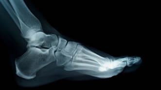 Foot and Ankle Fractures in the Pasadena, TX 77505, Baytown, TX 77521, Houston, TX 77089 & 77023, League City, TX 77573, Pearland, TX 77584 area