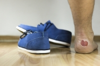 Causes of Foot Blisters