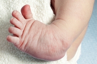 Clubfoot Is a Congenital Foot Condition
