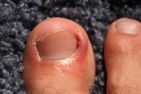 Are Ingrown Toenails Different From Toenail Fungus?