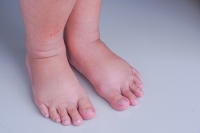 Reasons and Preventive Methods for Swollen Feet