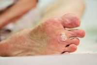 What is a Plantar Wart?