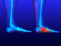 The Pros of Orthotics for Flat Feet