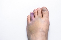 Causes and Care of a Broken Toe