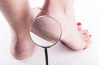 Cracked Heels May Be More Common Among Women