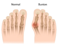 Can Wearing High Heels Cause Bunions?